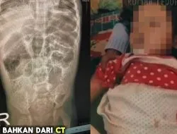 Analisis Tanggung Jawab Negara atas Kematian Anak Akibat Infeksi Cacing